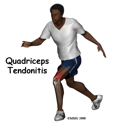 Quadriceps Tendonitis of the Knee
