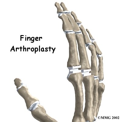 Artificial Joint Replacement of the Finger - Physio Connect's Guide
